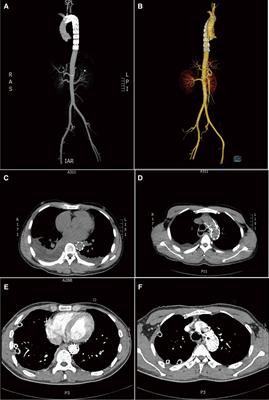 Salvaged, Staged, and Safer Management of Aortoesophageal Fistula and Mediastinitis After Removing a Pork Bone: A Case Report
